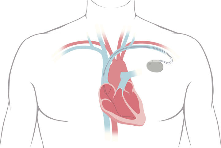 Schematizzazione grafica del posizionamento del pacemaker nel petto.