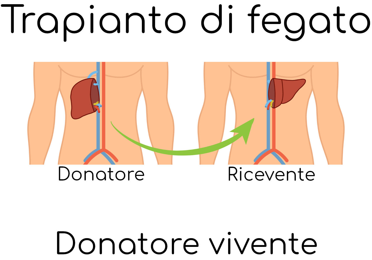 Grafica semplificata in cui si vede che il ricevente acquisice mezzo fegato dal donatore vivente.