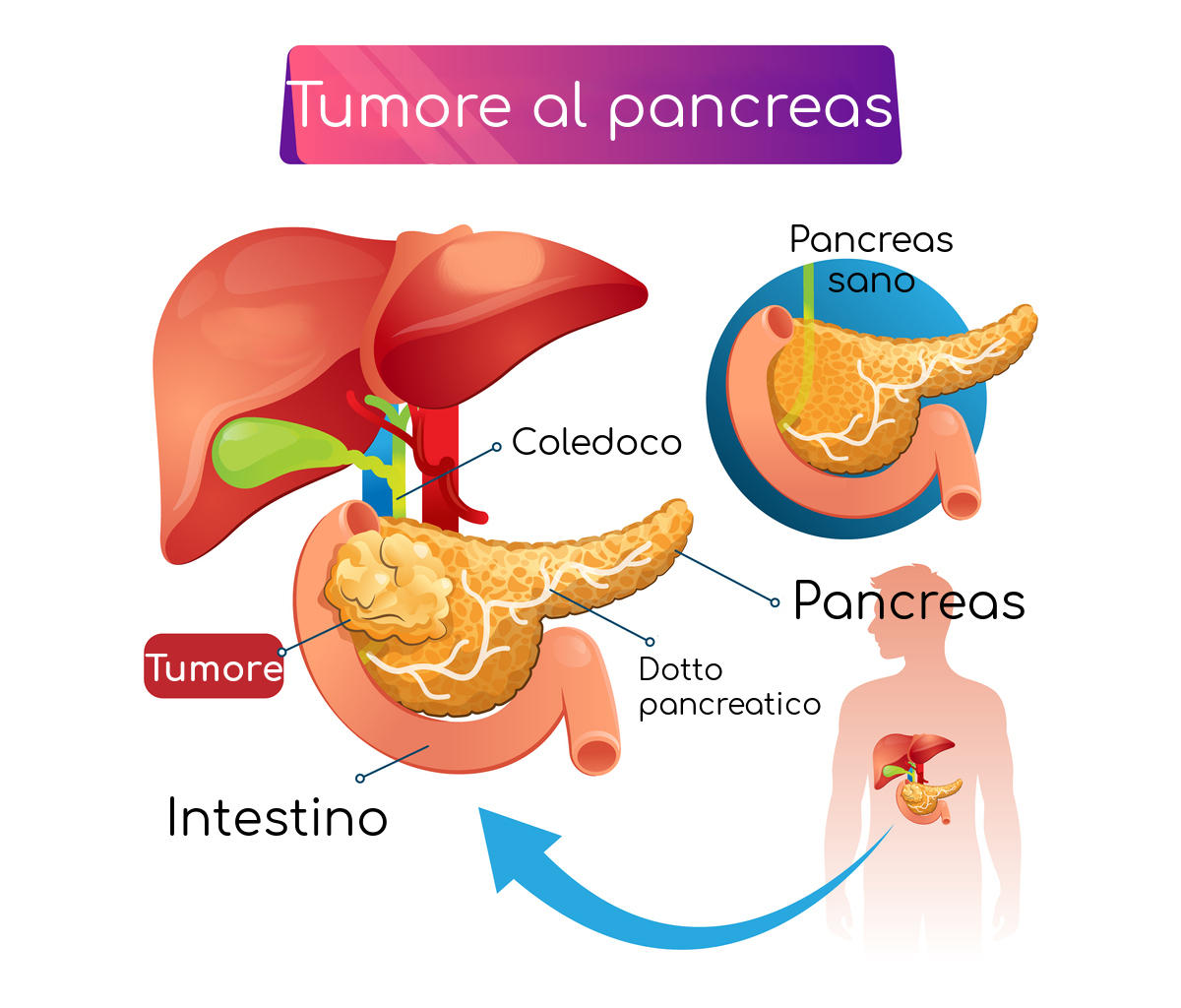 Esemplificazione dell'anatomia del tumore al pancreas