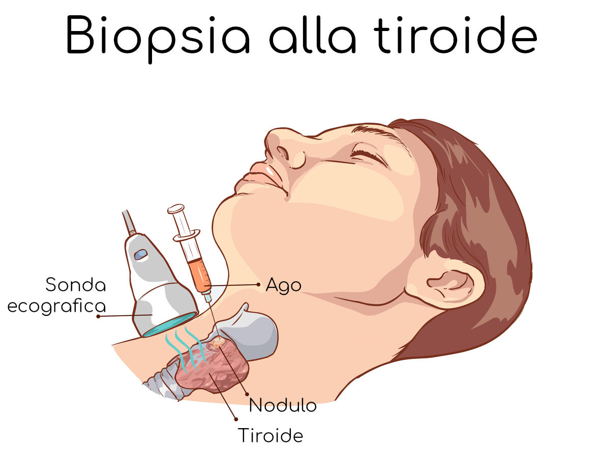 Disegno che mostra come avviene una biopsia tiroidea ecoguidata