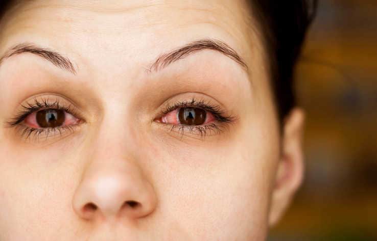 Primo piano di donna con gli occhi fortemente arrossati da congiuntivite