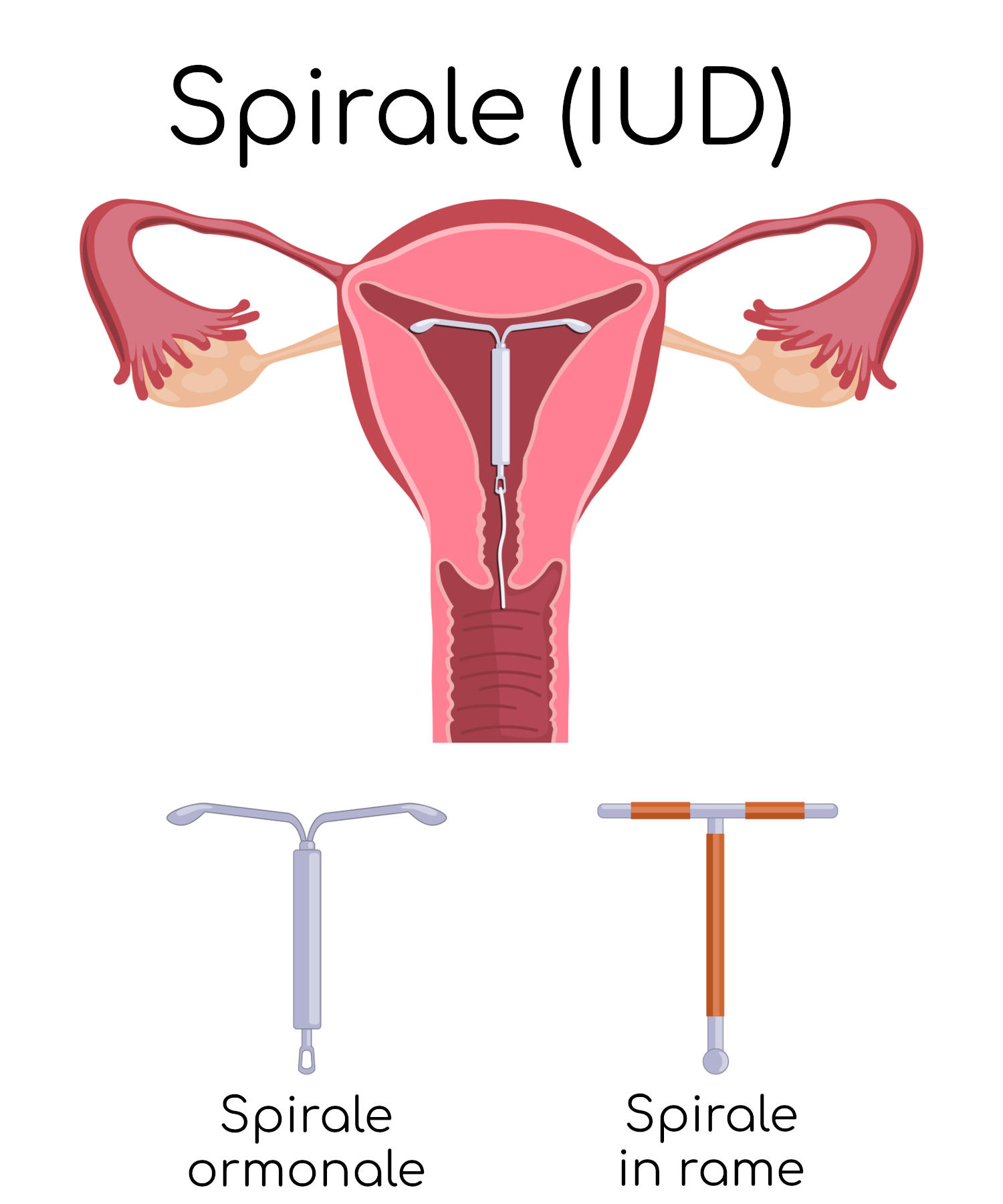 DIfferenza tra spirale ormonale e in rame