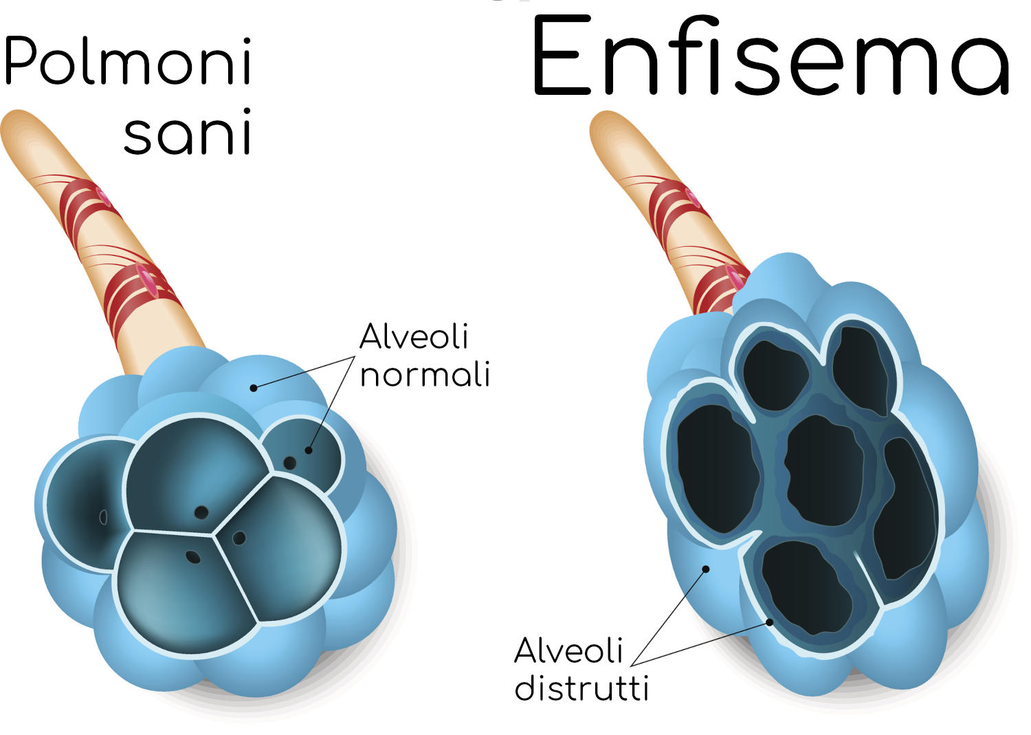 Enfisema polmonare
