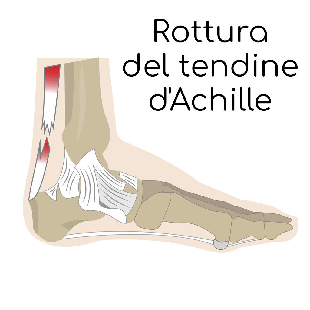Anatomia semplificata del tendine rotto