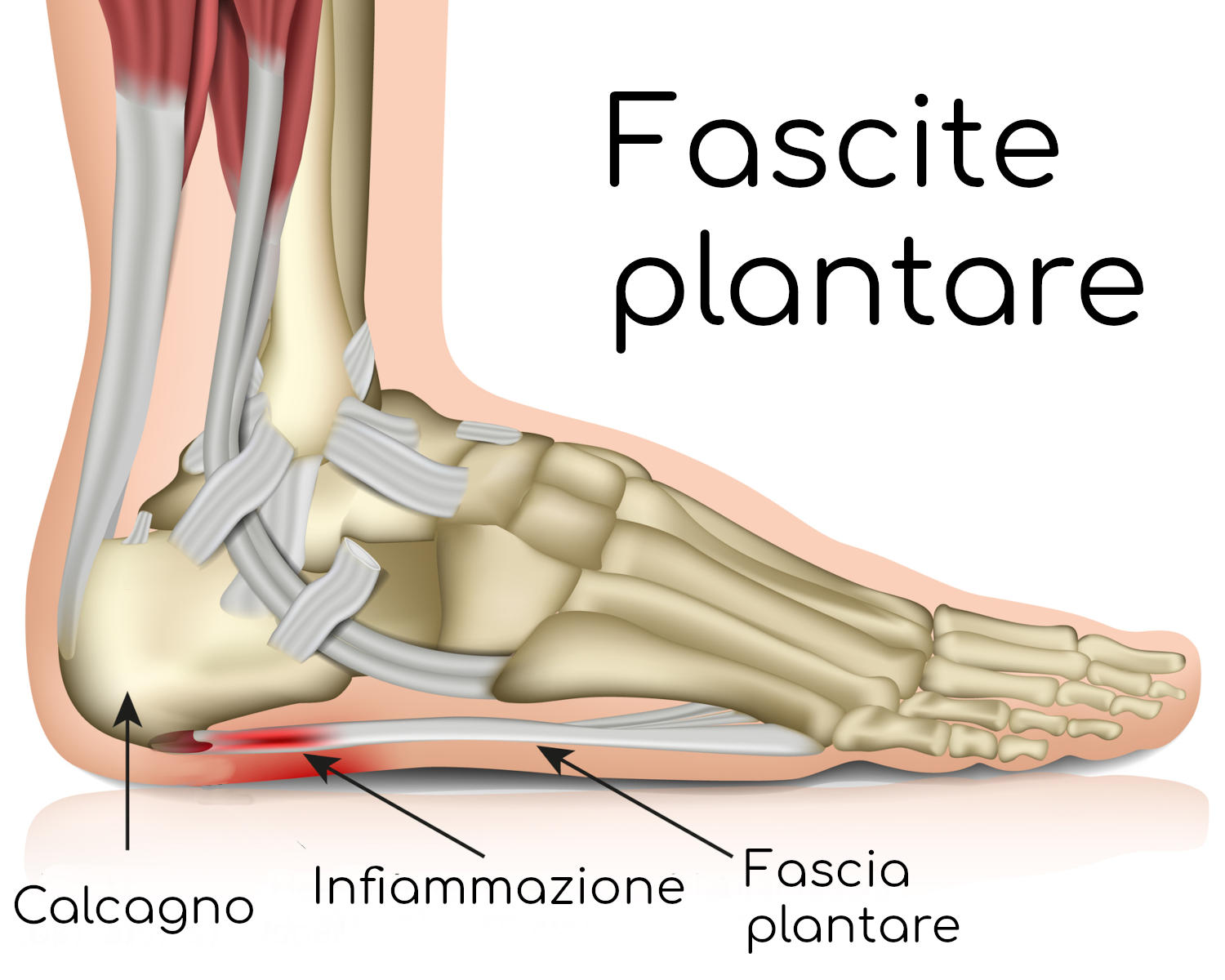Anatomia della fascite plantare