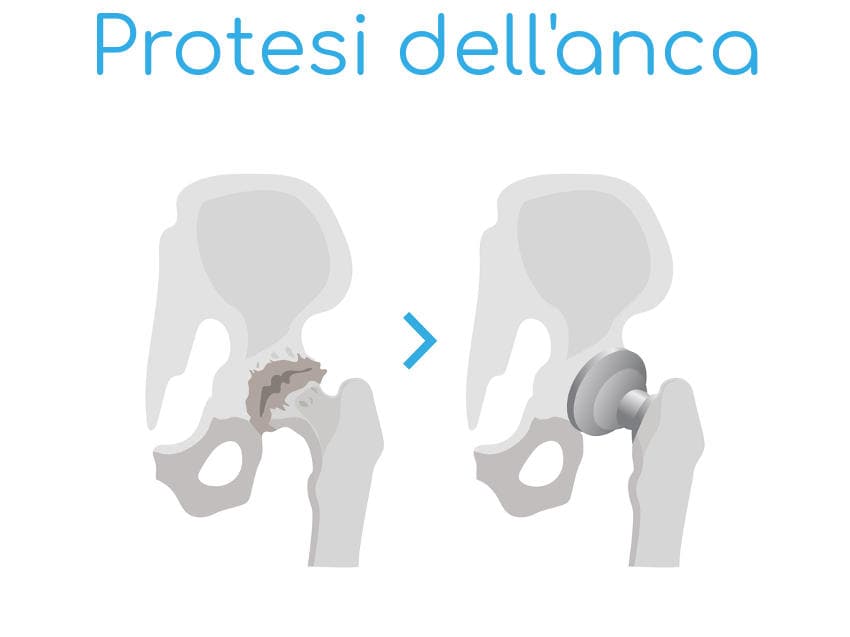 Semplificazione dell'articolazione dell'anca