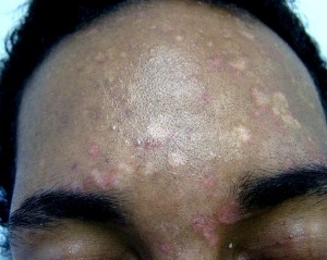 Tinea versicolor Tinea versicolor