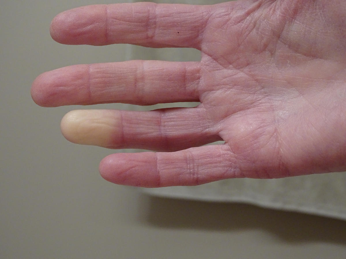 Fenomeno di Raynaud su un dito della mano