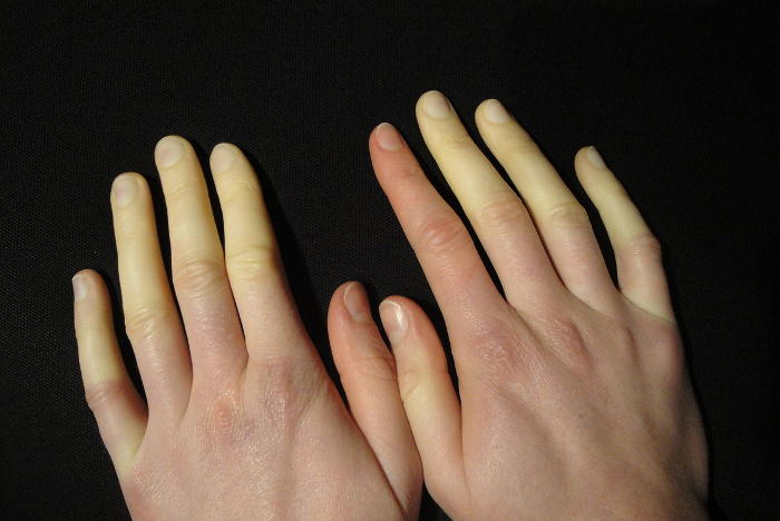 Fotografia di due mani colpite da Raynaud, che presentano le dita bianchissime.
