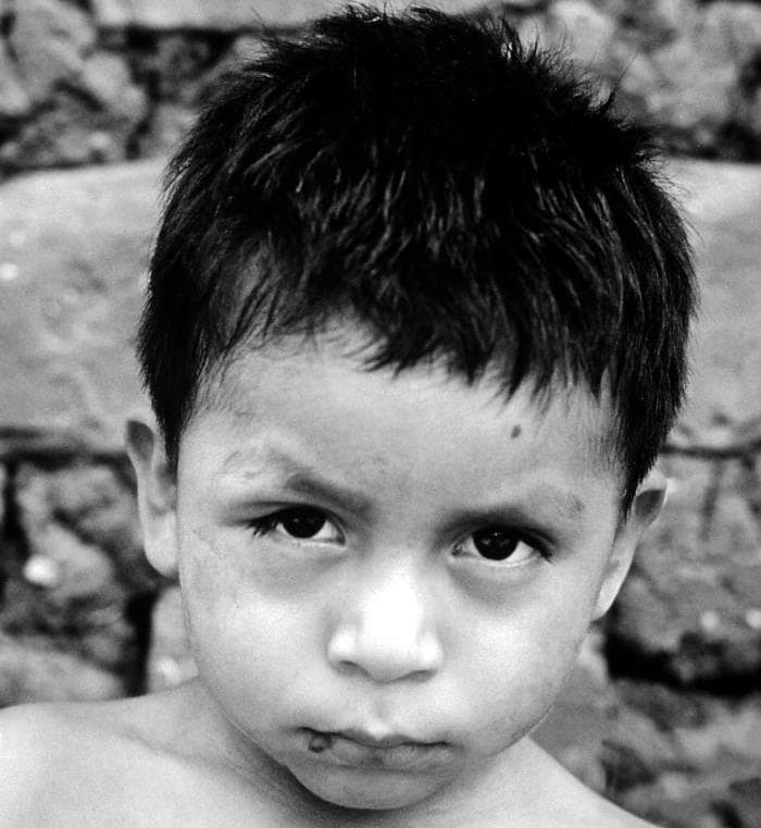 Fotografia di un bambino con il tipico segno di Romaña
