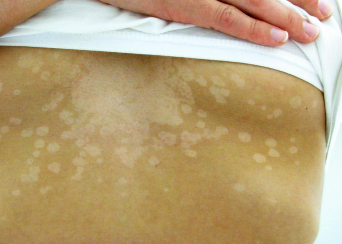 Immagine di una donna affetta da pitiriasi versicolor