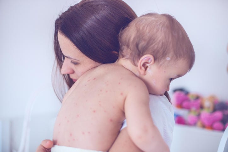 Fotografia di una mamma che abbraccia il figlio piccolo colpito da varicella