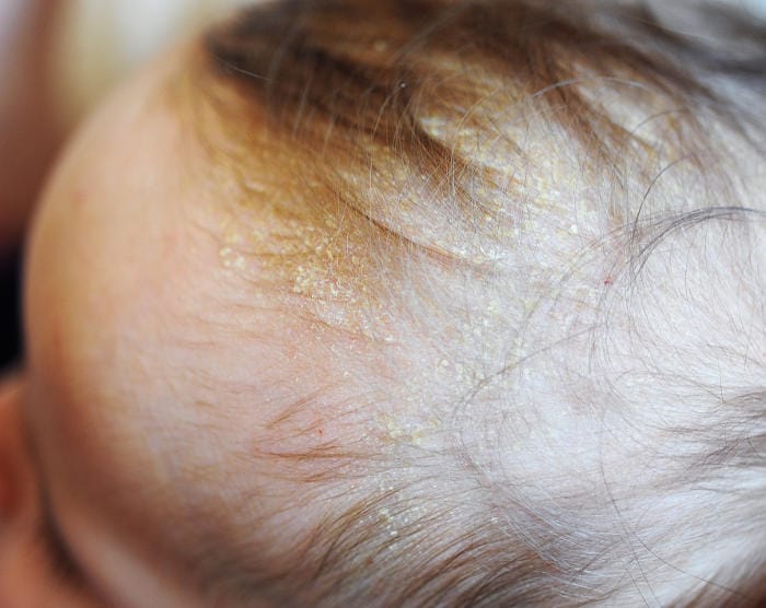 Primo piano della crosta lattea in un neonato