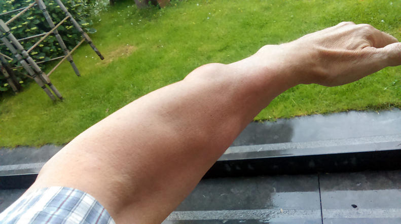 Immagine di un lipoma sul braccio