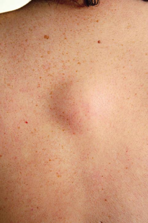 Fotografia di un lipoma sulla schiena