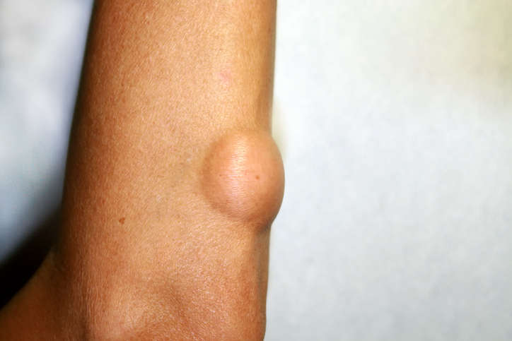 Fotografia di un lipoma su un braccio
