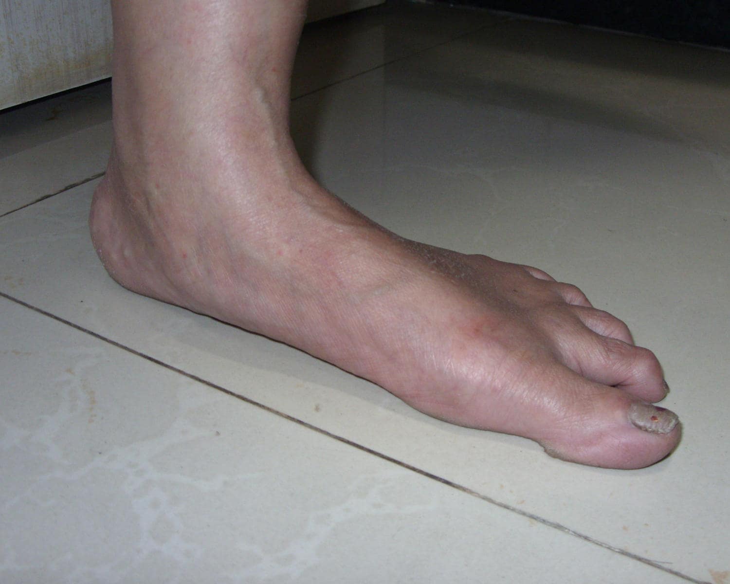 Piede piatto