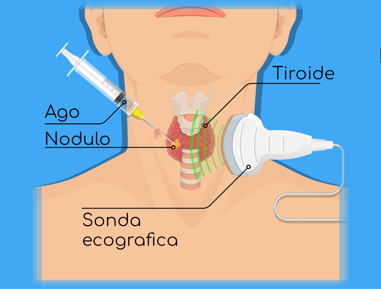 Biopsia con ago aspirato