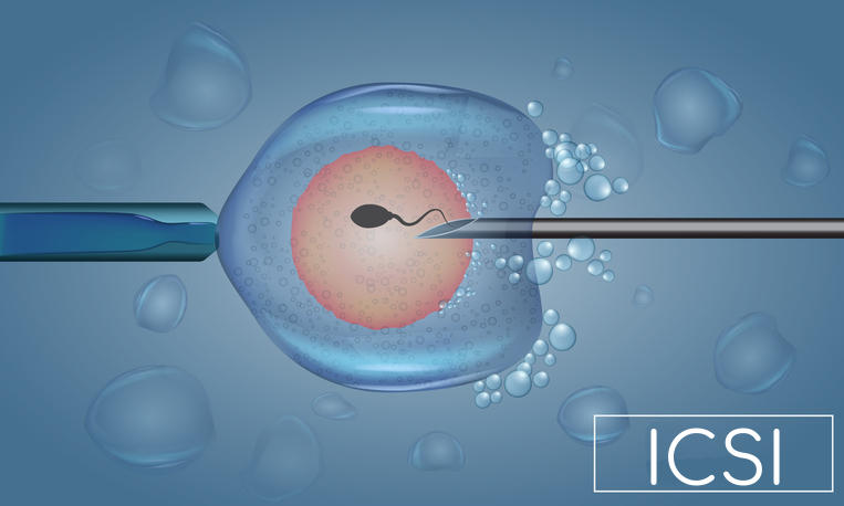 Procedura di fecondazione tipica della ICSI