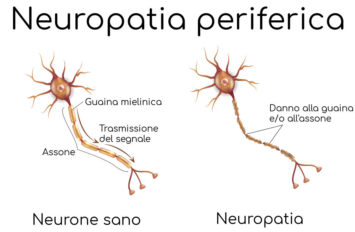 Neuropatia periferica e tipo di danno (assone e/o guaina)