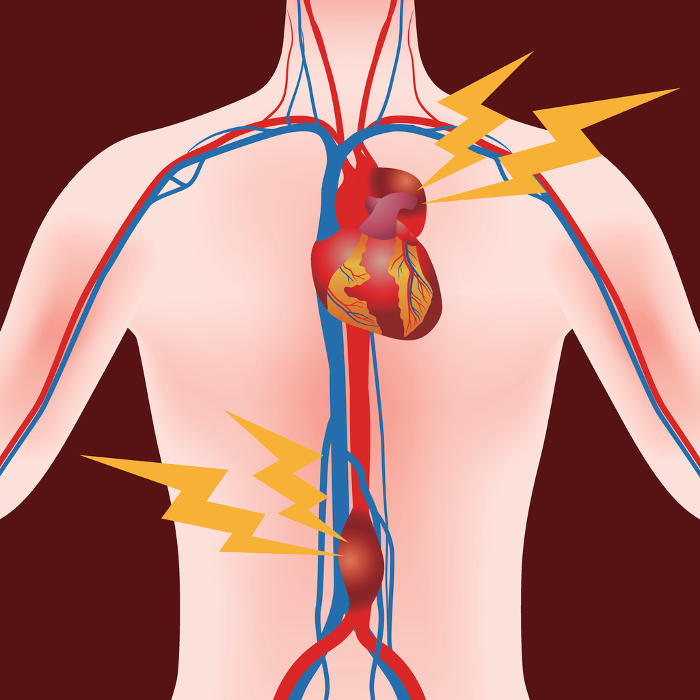 Ricostruzione grafica semplificata dell'anatomia alla base dei due tipi di aneurisma dell'aorta.