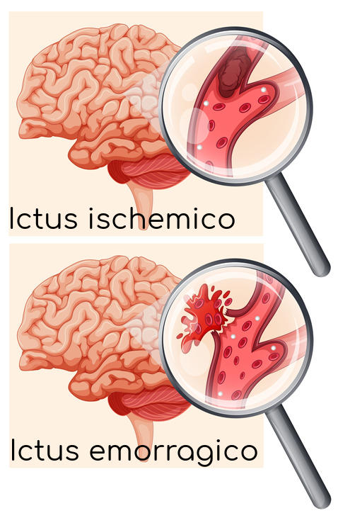 Schematizzazione dei due diversi tipi di ictus