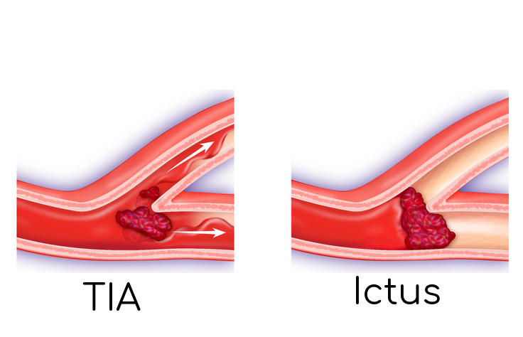 Schematizzazione di ictus e TIA
