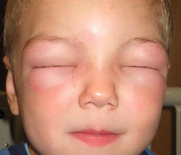 Bambino che non riesce ad aprire gli occhi a causa di angioedema
