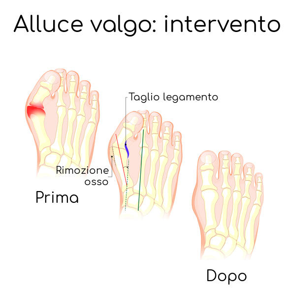 Semplificazione dell'operazione per alluce valgo.