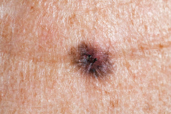 Fotografia di un melanoma