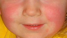 Foto della maschera scarlattinosa