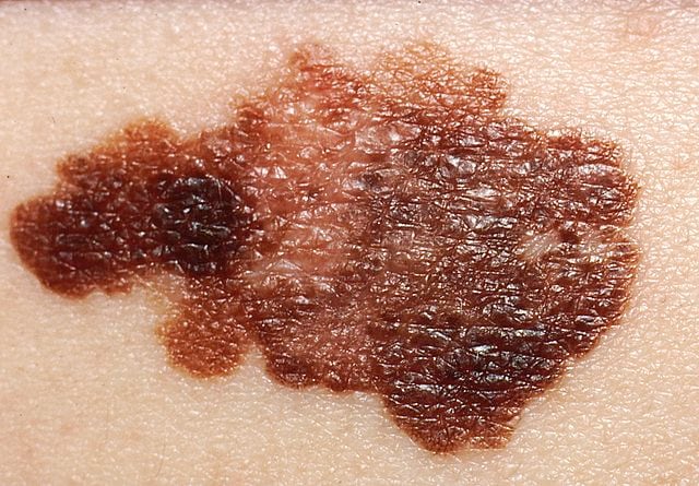 Immagine di esempio di un melanoma