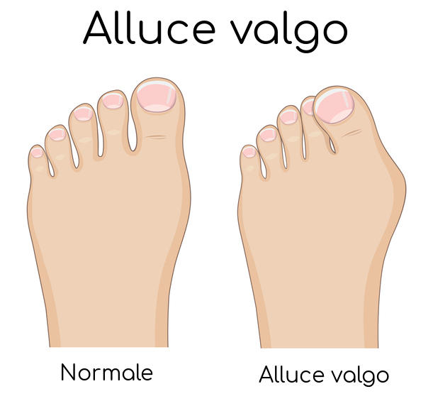 Schematizzazione dell'alluce valgo