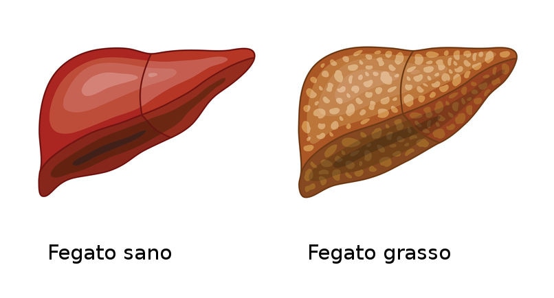 Ricostruzione grafica della differenza tra fegato normale e fegato grasso, che appare ricco di accumuli di grasso