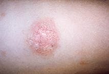 Fotografia della chiazza madre che compare con la pitiriasi rosea