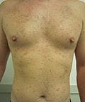 Fotografia con il tipico rash cutaneo della pitiriasi rosea