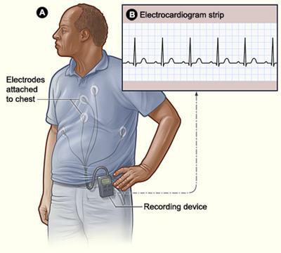 Rappresentazione dell'elettrocardiogramma dinamico