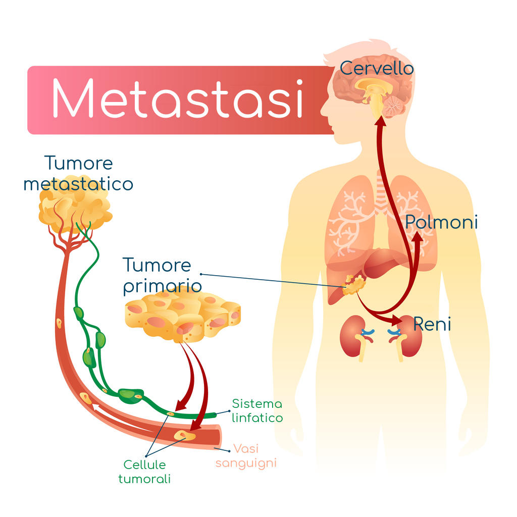 Semplificazione del meccanismo delle metastasi del tumore al fegato