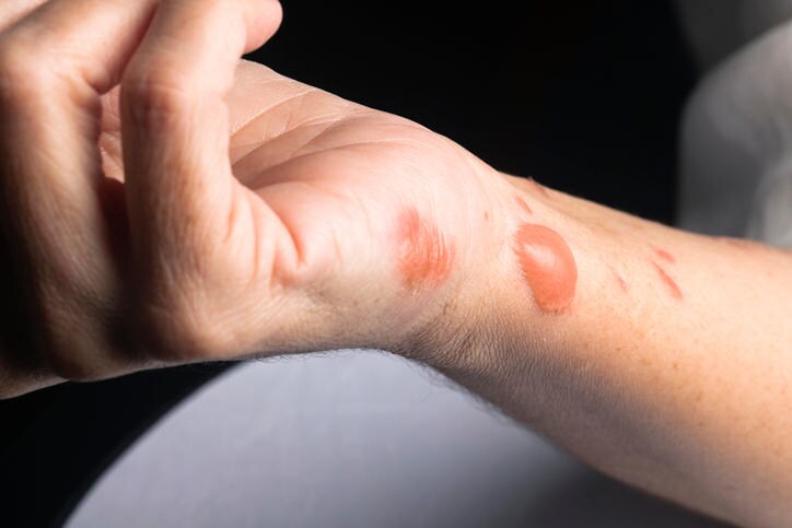 Fotografia di un'ustione di secondo grado sulla mano