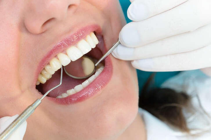 Primo piano di una bocca aperta e del dentista che ne verifica la salute e la corretta igiene.