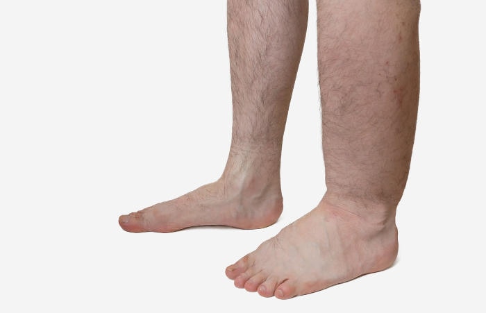 Fotografia di un paziente con un chiaro edema alla gamba