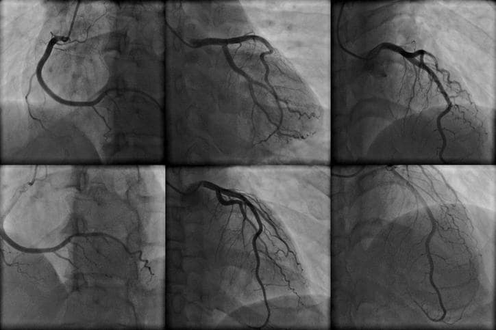 Esempio delle immagini catturate dall'angiografia coronarica