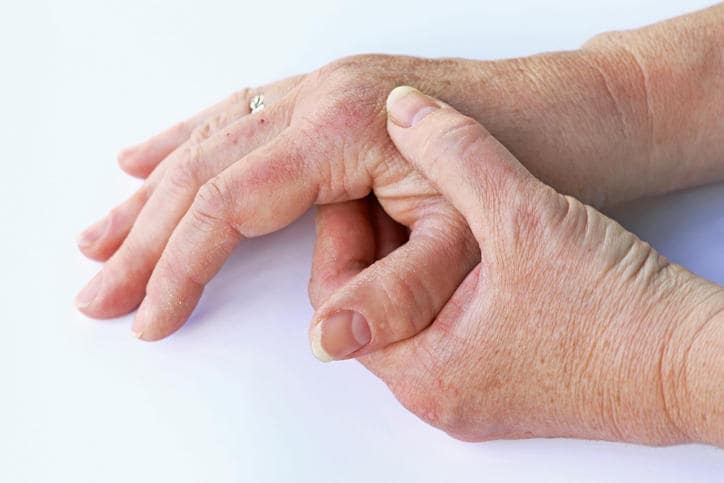 Primo piano di due mani femminili doloranti a livello articolare