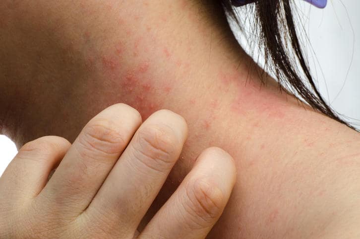 Fotografia di una dermatite sul collo di una ragazza