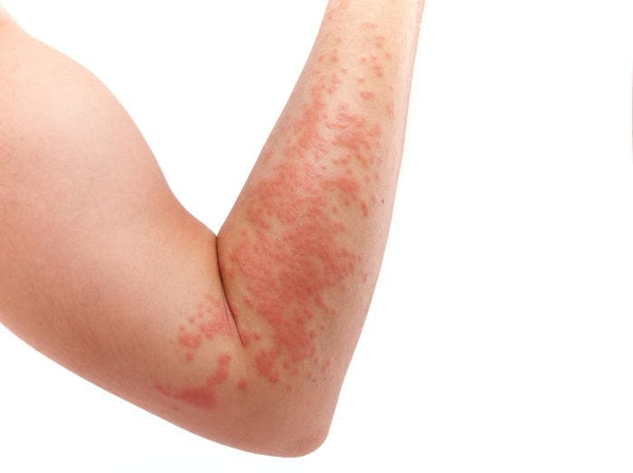 Fotografia di una dermatite sul braccio