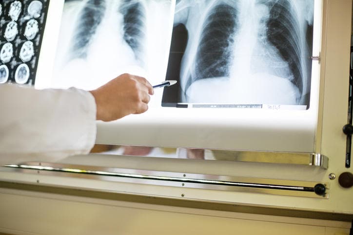 Dottore che valuta una radiografia ai polmoni