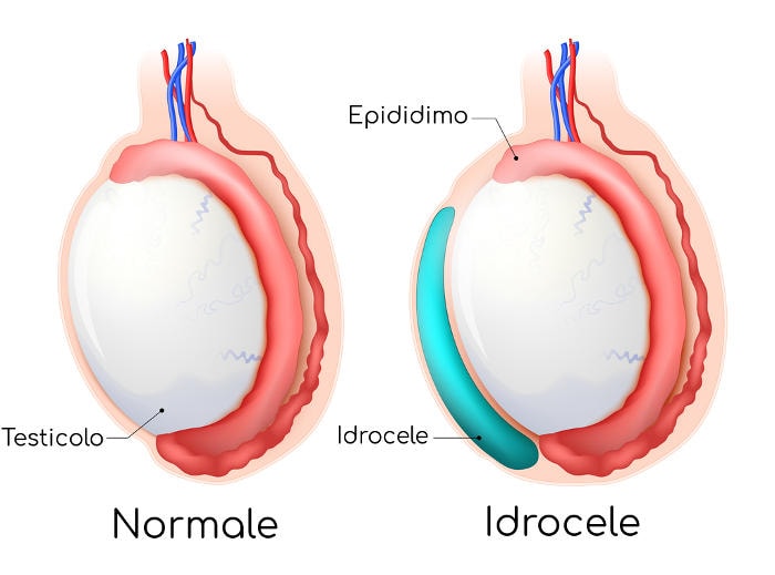 Schematizzazione dell'idrocele