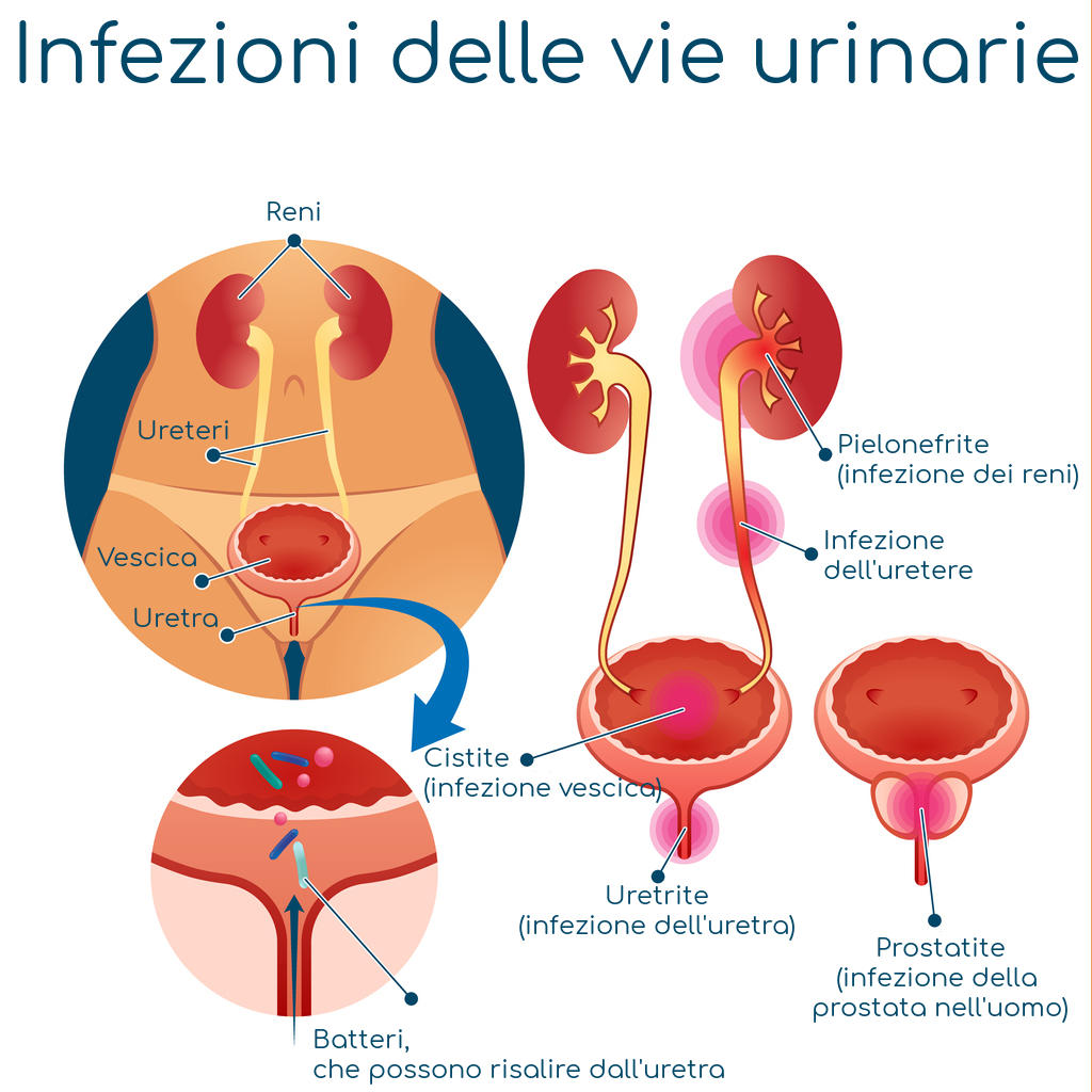 Infezioni delle vie urinarie, semplificazione