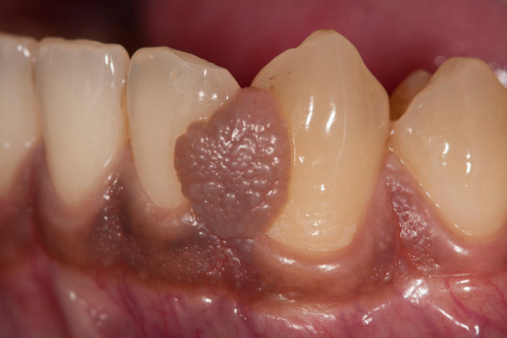 Granuloma piogenico orale