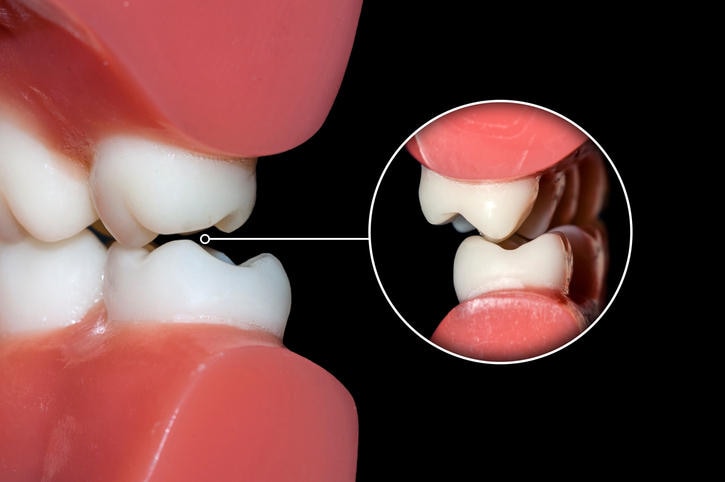 Primo piano di una malocclusione dentale